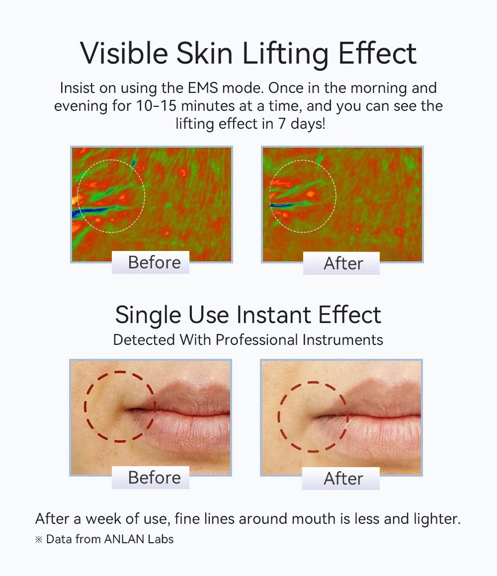 ANLAN Ohio EMS Pro – Lifting visage, rajeunissement, compresses chaud/froid